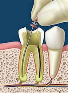 Làm gì khi răng bị hư tủy?