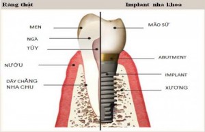 Tại sao trồng răng giả implant có chi phí cao? 