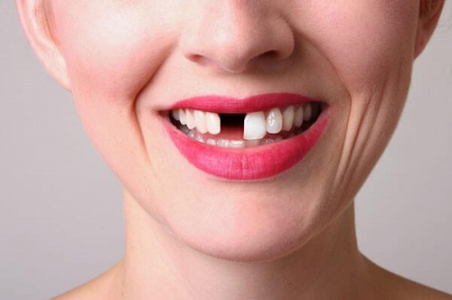 Bọc răng sứ khi mất răng được thực hiện ra sao? 1