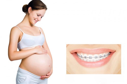 Niềng răng bao lâu thì nên có bầu? Lưu ý khi niềng răng-1